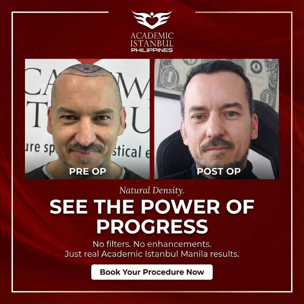 Hair transplant before and after result 1 — Academic Istanbul