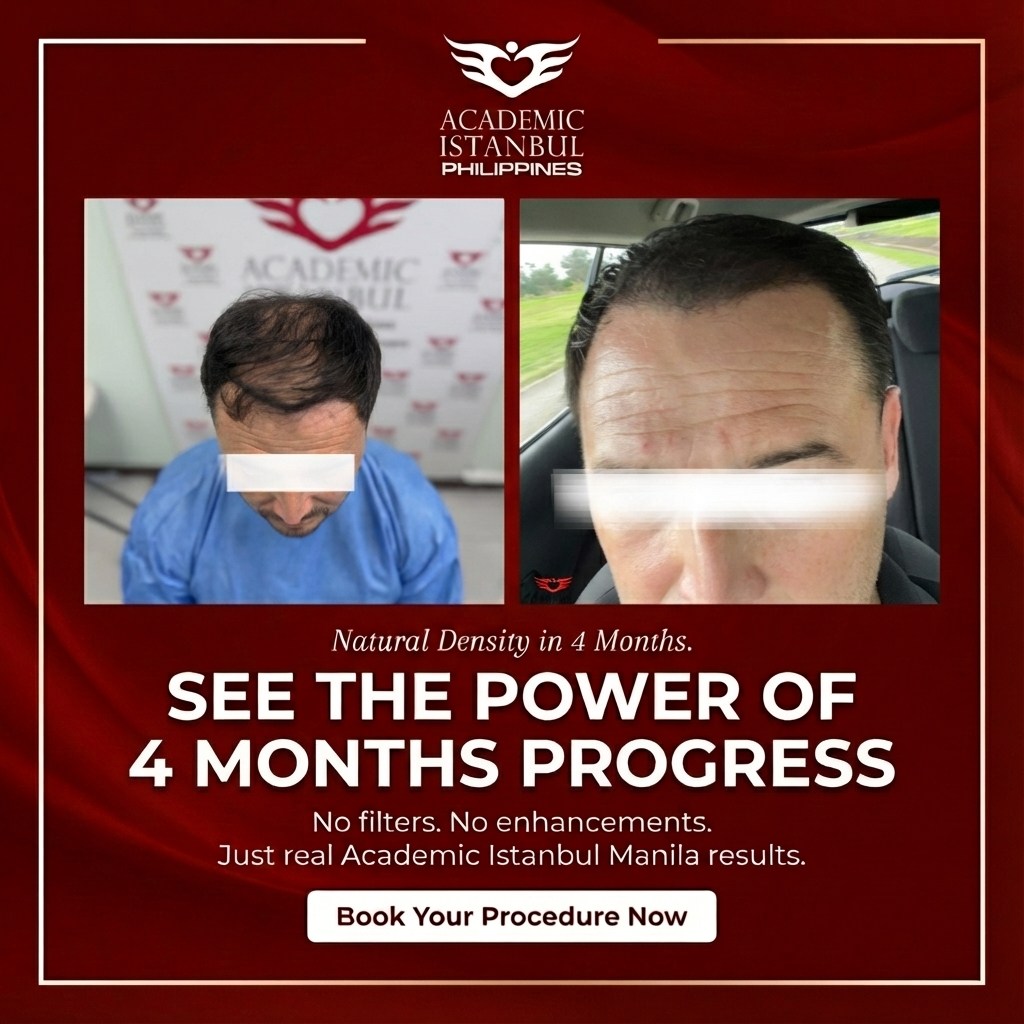 Hair transplant before and after result 7 — Academic Istanbul