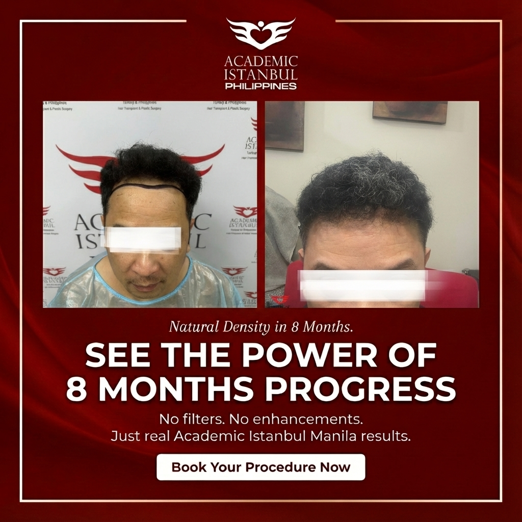 Hair transplant before and after result 5 — Academic Istanbul