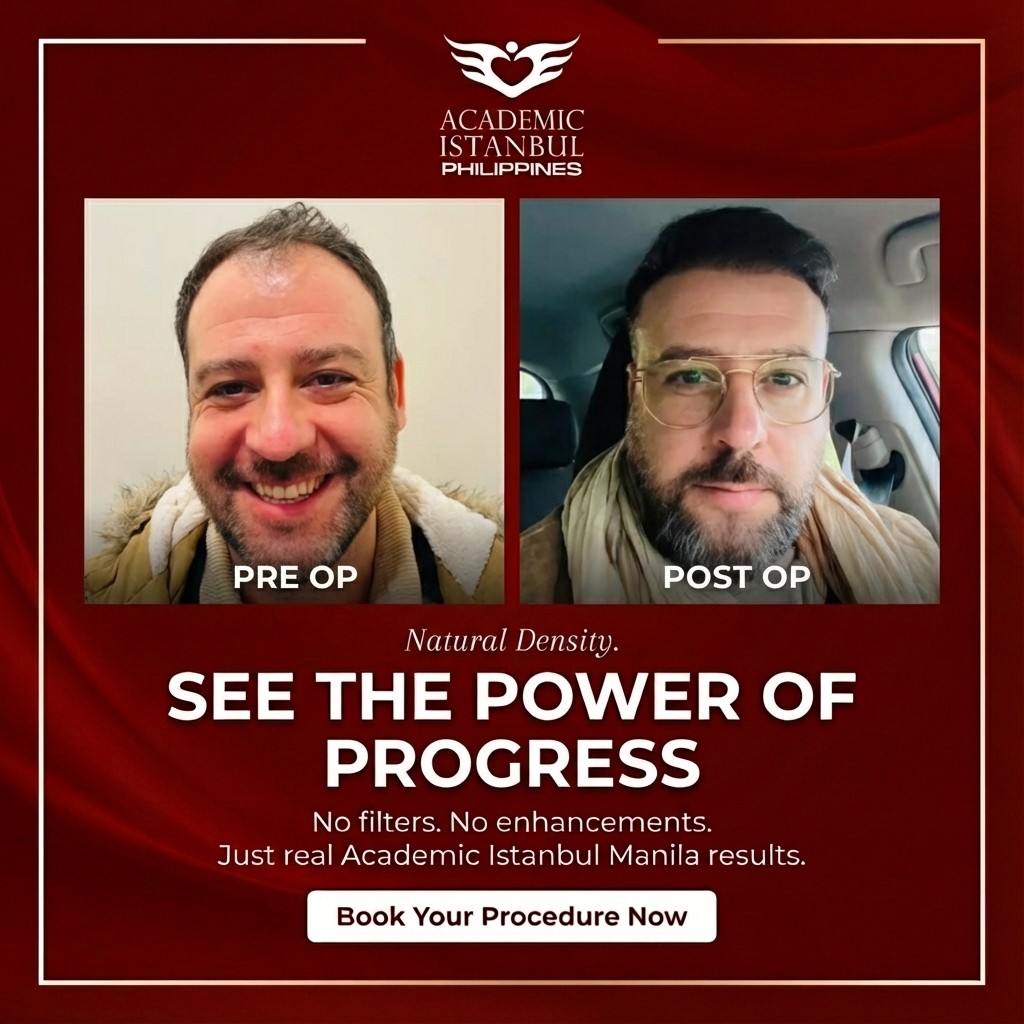 Hair transplant before and after result 3 — Academic Istanbul