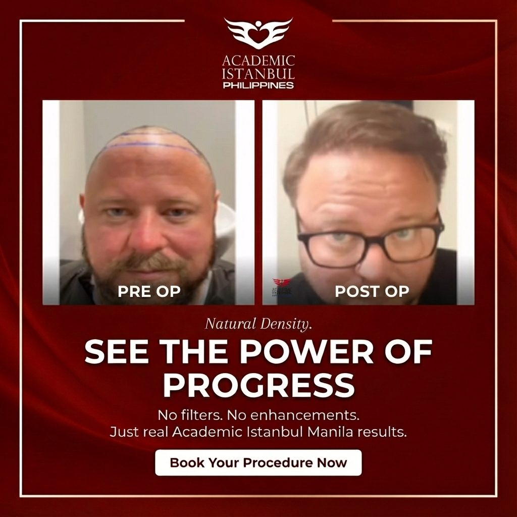 Hair transplant before and after result 4 — Academic Istanbul