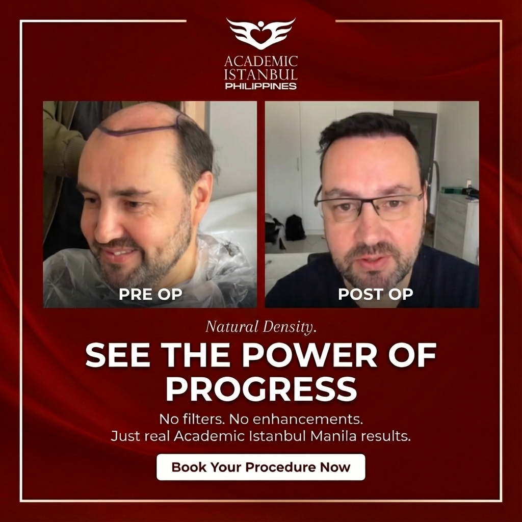 Hair transplant before and after result 2 — Academic Istanbul